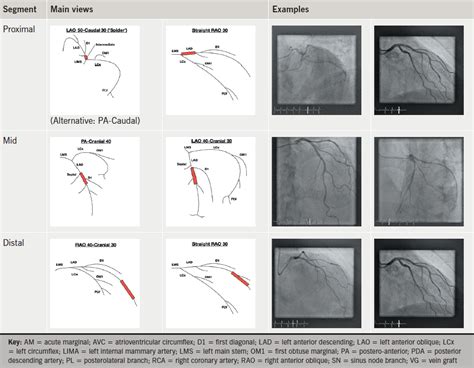 A Guide To Coronary Angiogram In The Philippines.